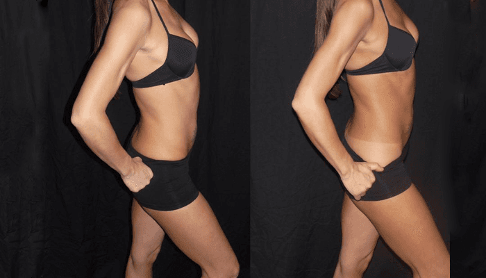 Body Contouring After Weight Loss Before and After Photo Gallery, Albany &  Latham, New York